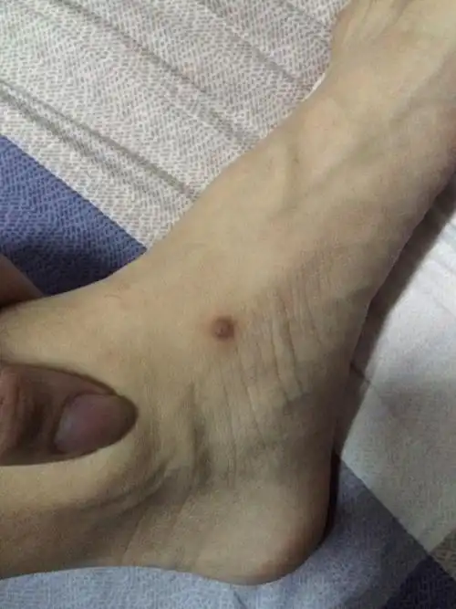 脚踝长了个疙瘩 深色的 大半年都没消