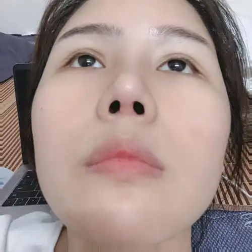 做的肋骨鼻半年了鼻小柱切口疤内凹怎么办修复是要做鼻小柱延长还是鼻