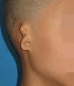 一张流程图轻松掌握3度先天性小耳畸形诊治方案