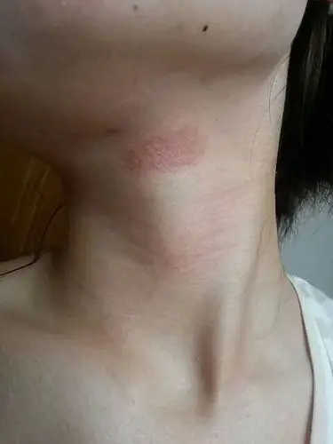 问:我脖子上半年前发了块过敏的疹子,到现在也没好.