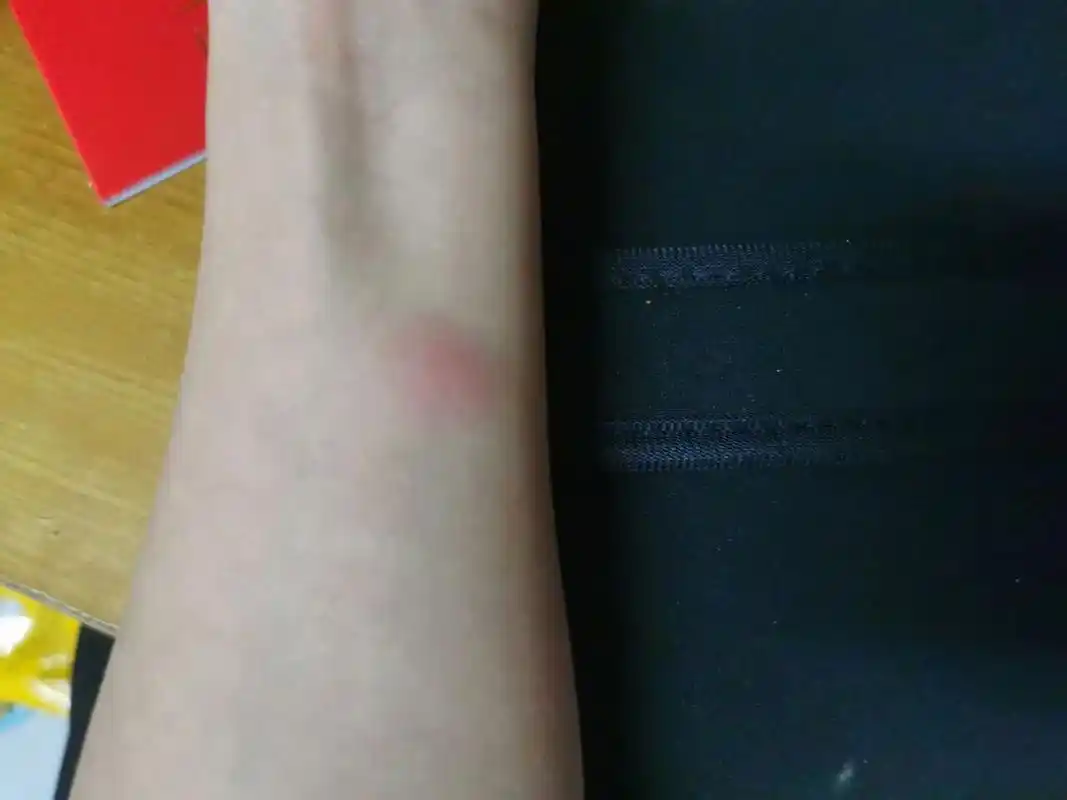 ppd皮试第二天(24小时) 开始红了一点,大概一个指甲盖,不痛不痒