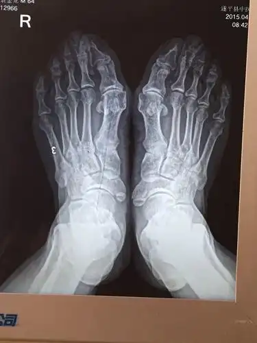 大脚骨病的微创手术