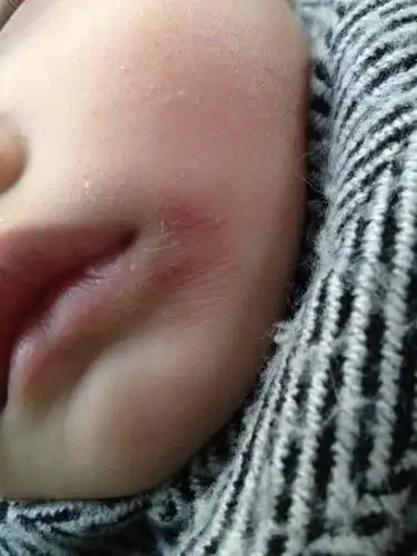 一岁四个月宝宝嘴角起病毒性疱疹,摸了药膏,然后变成这样了,怎么办呢