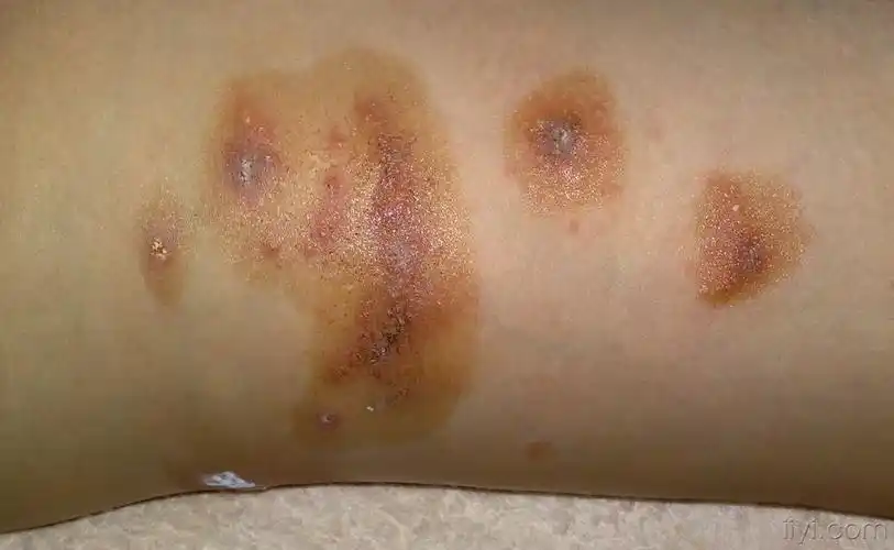 求助.什么类型呢! - 皮肤及性传播疾病讨论版 - 爱爱医医学论坛