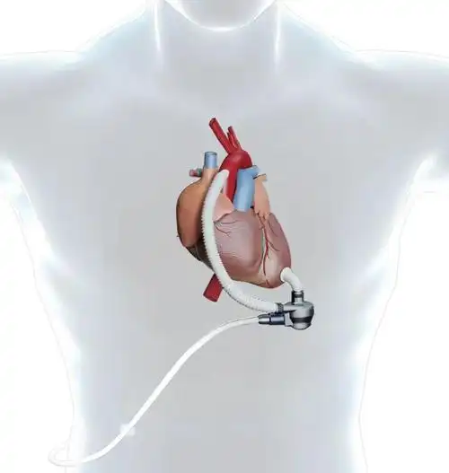 山东首例国产人工心脏植入手术顺利完成