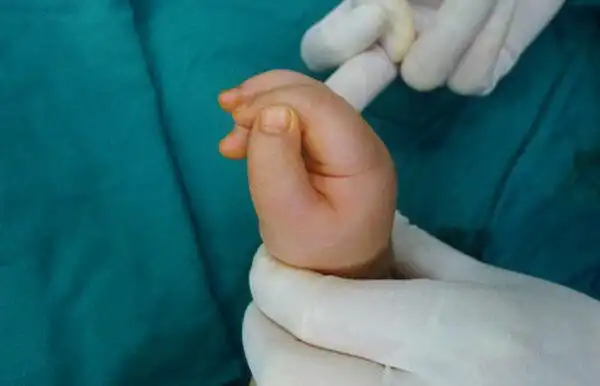 拇指侧弯畸形三节指骨矫正