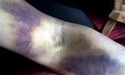 女子醒后发现全身都是淤青去医院检查医生的一句话陷入绝望