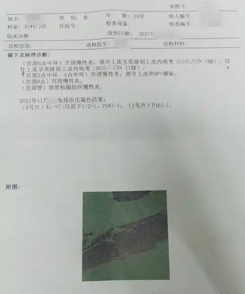 20岁女孩人流后感染hpv58