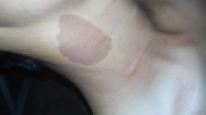 手腕有胎记的人命运_胎记长在后脑勺命运_胎记的位置与命运