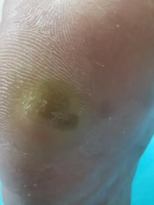 门诊足底皮样囊肿1例_蔡思龙_副主任医师_爱问健康