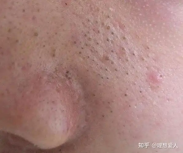 我应该拿这个巨大的黑头怎么办?具体咋样去掉? - 知乎