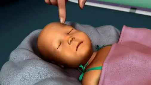 新生儿黄疸图片