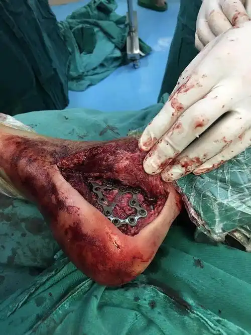 又一例左侧跟骨粉碎性骨折在我院骨科顺利完成! - 美篇