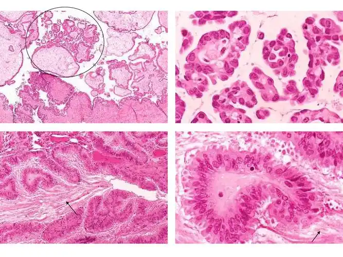 卵巢浆液性交界性肿瘤的病理诊断