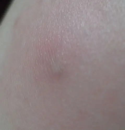 大概半个月左右了,一开始不在意,大腿上长了个硬疙瘩,有点红,中心有个