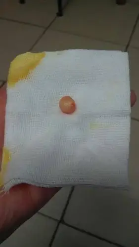 粉瘤切除手术可以报医保吗 粉瘤医保