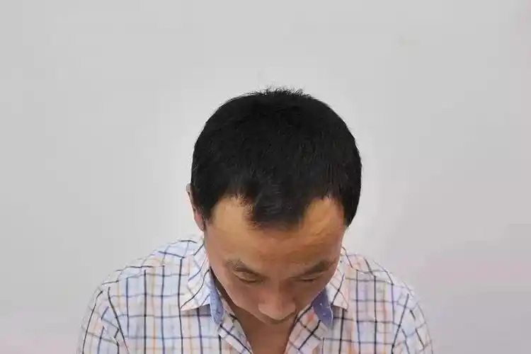 头发每天大把掉秃顶发际线后移头顶稀疏原因居然是这样