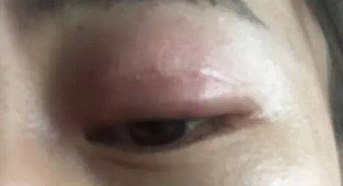 左眼上眼皮肿了三天了,发痒,按压会疼.