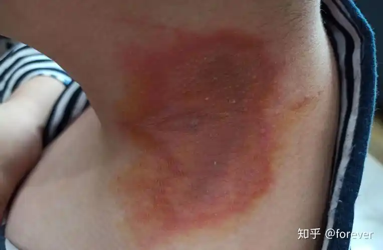 被影翅虫咬了怎么办呀 - 知乎