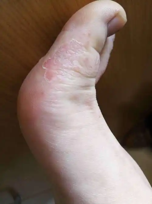 脚上起了好多小水泡,痒痒,是怎么回事?