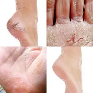 手脚开裂干裂干燥脱皮掉皮修复霜季节性手起水泡手部护理去死皮