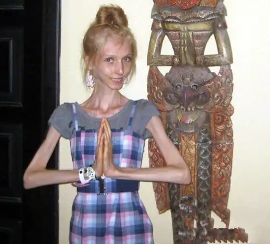 全世界上最瘦的人 俄罗斯美女只有20公斤(组图)