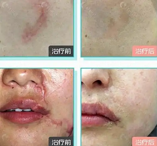 成都较好的疤痕修复医院合集医大整形四川友谊医院上榜