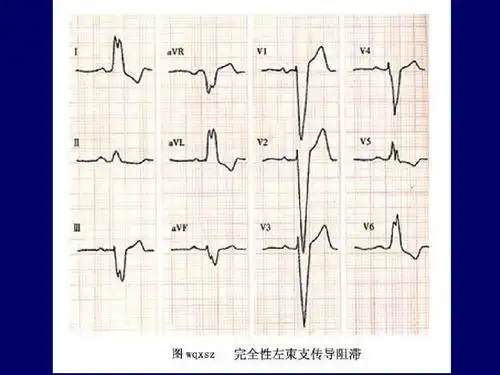 异常心电图图谱汇总ppt