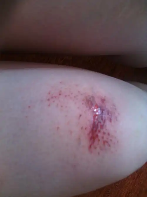 我腿在三天前摔伤,我一直用双氧水擦伤口,好像有一