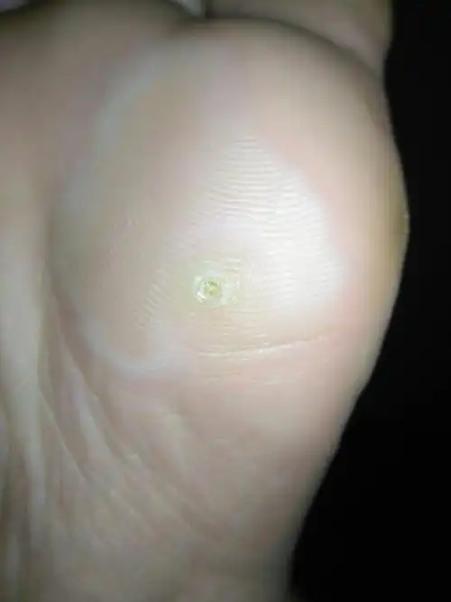 这个是鸡眼吗!还有边上一圈白白的是什么?