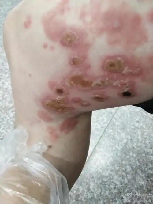 56岁慢性,双下肢皮疹,初起大片红斑