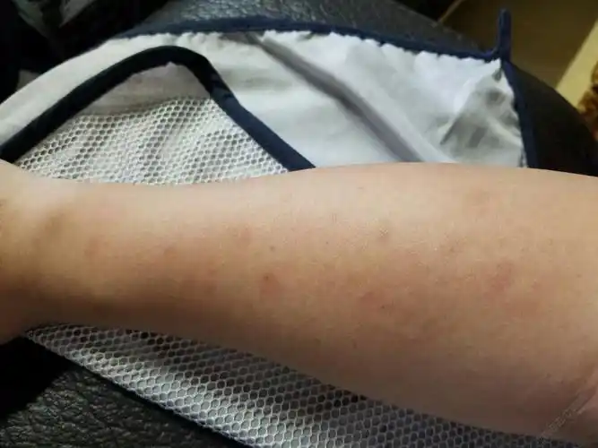 小手臂上张黑斑