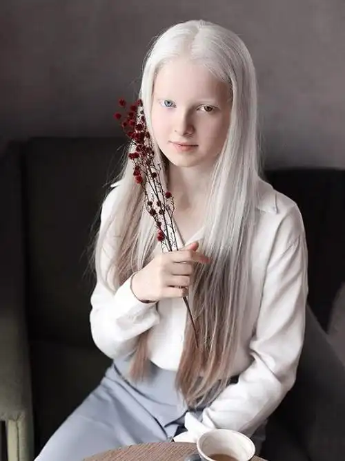 患有白化病和虹膜异色症,这个女孩简直空灵脱俗如精灵