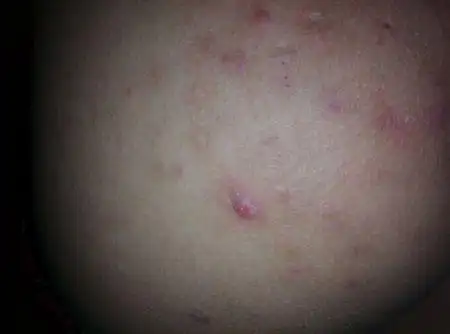 屁股上长了一片 这种痘痘是什么病? 看图