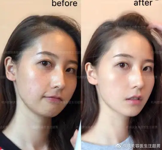 光子嫩肤治疗前后对比