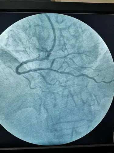 面对冠心病选择冠脉造影还是冠脉ct