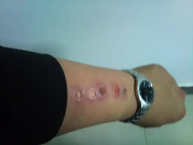 可是昨天再在我空间给我评价了相册那个图片是我的胳膊上烫的烟头.