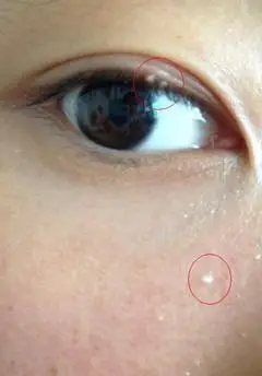 为什么眼睛周围总是长脂肪粒?去得掉吗?