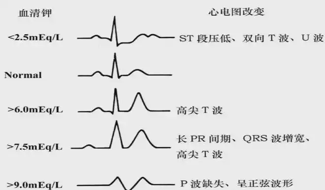 高钾血症典型心电图表现出现上述症状应立即到医院就诊4.