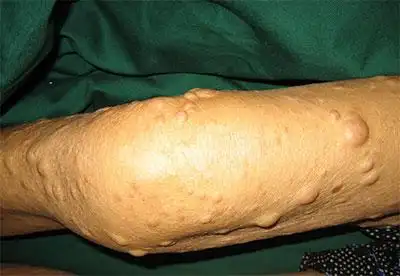 脂肪瘤能不能报销 好医保脂肪瘤