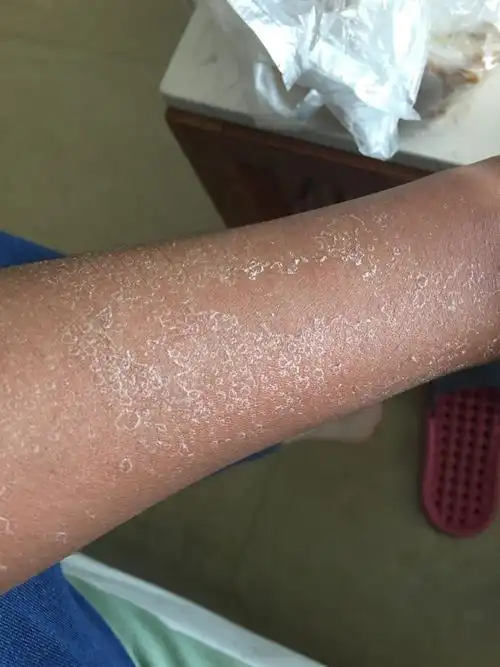 军训晒黑了 然后现在手这样 怎么办?