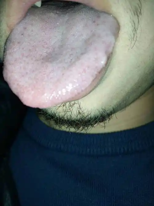 为什么我舌头会这样,肿两点?