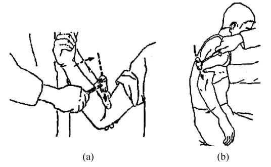 人体腱反射检查