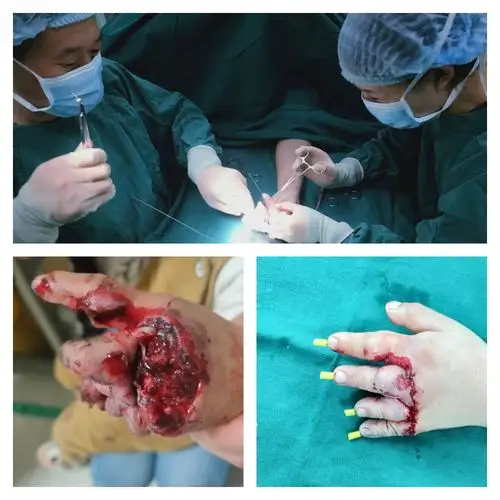 劳动节,致敬奋战在一线的九八八医院手外科人!