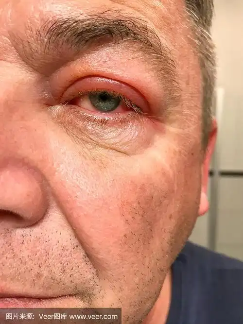 人的眼睛,炎症,红色,男人,特写