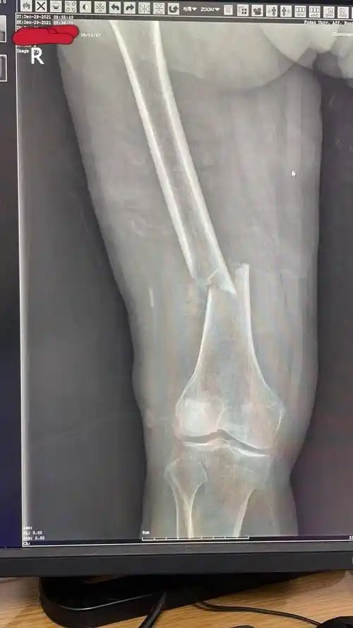 70岁老人不慎扭伤导致大腿骨折,竟然是恶性肿瘤骨转移