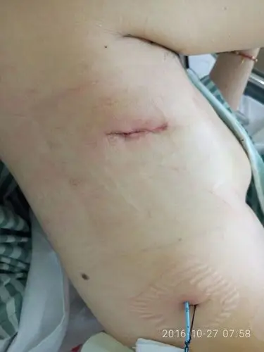 目前我主刀完成单孔胸腔镜下右肺上叶切除术 纵膈淋