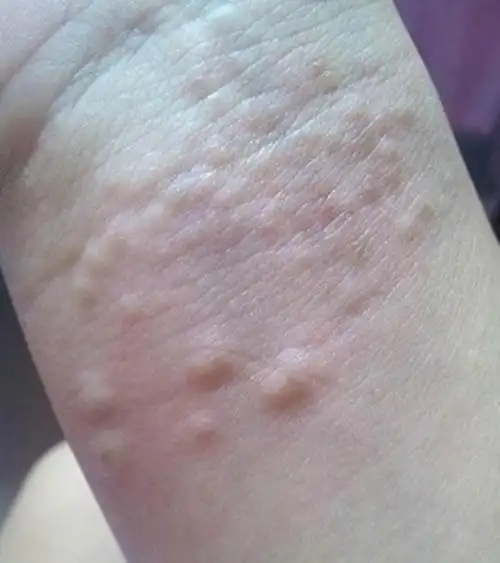 淋巴结肿大与这5种病息息相关患者要当心了