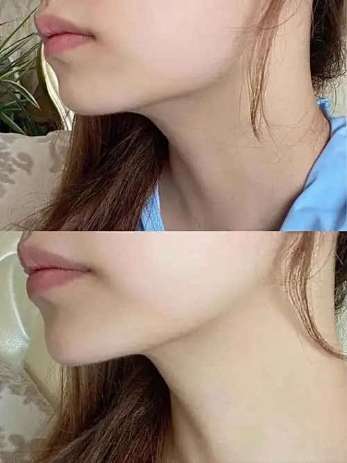 我去打了玻尿酸下巴