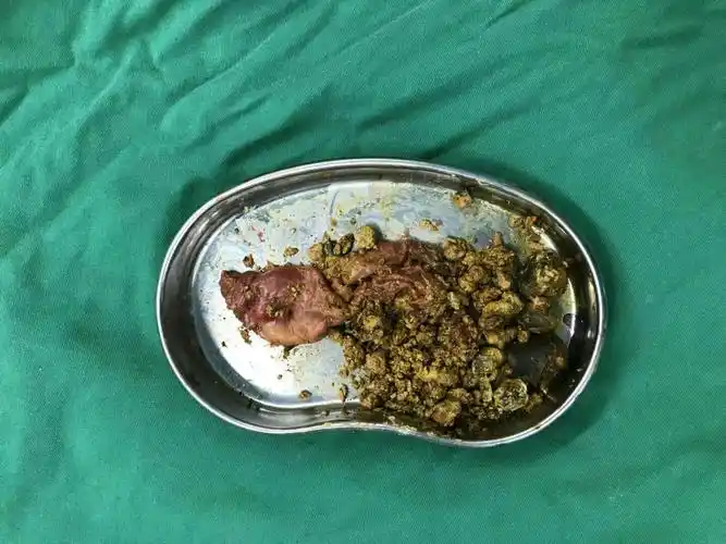 充满型胆囊结石 - 好大夫在线